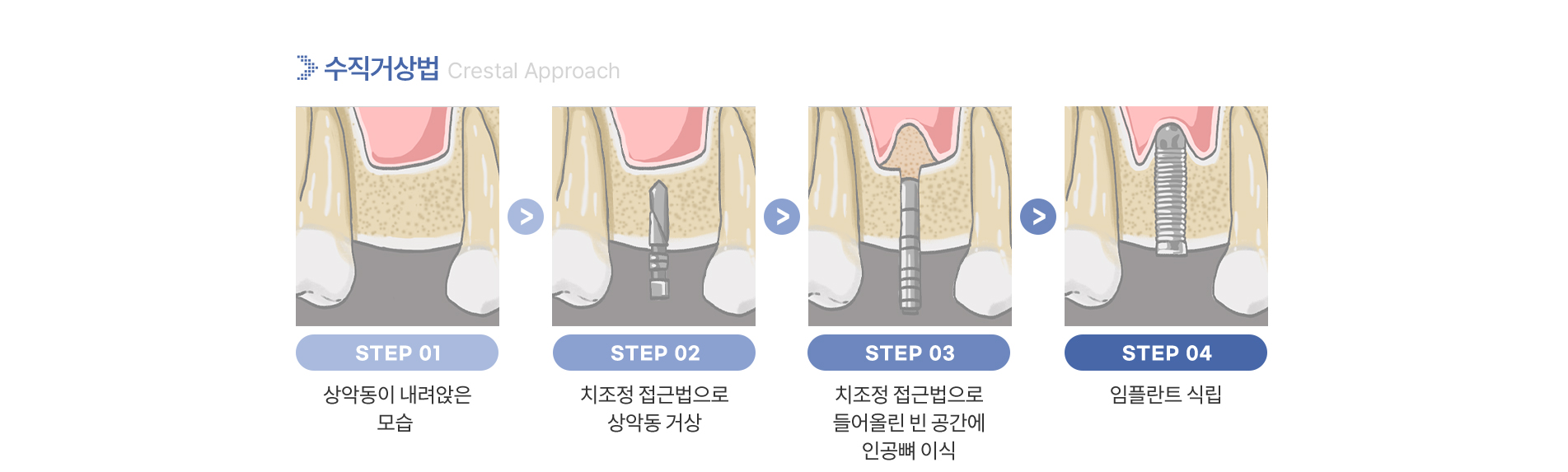 임플란트센터