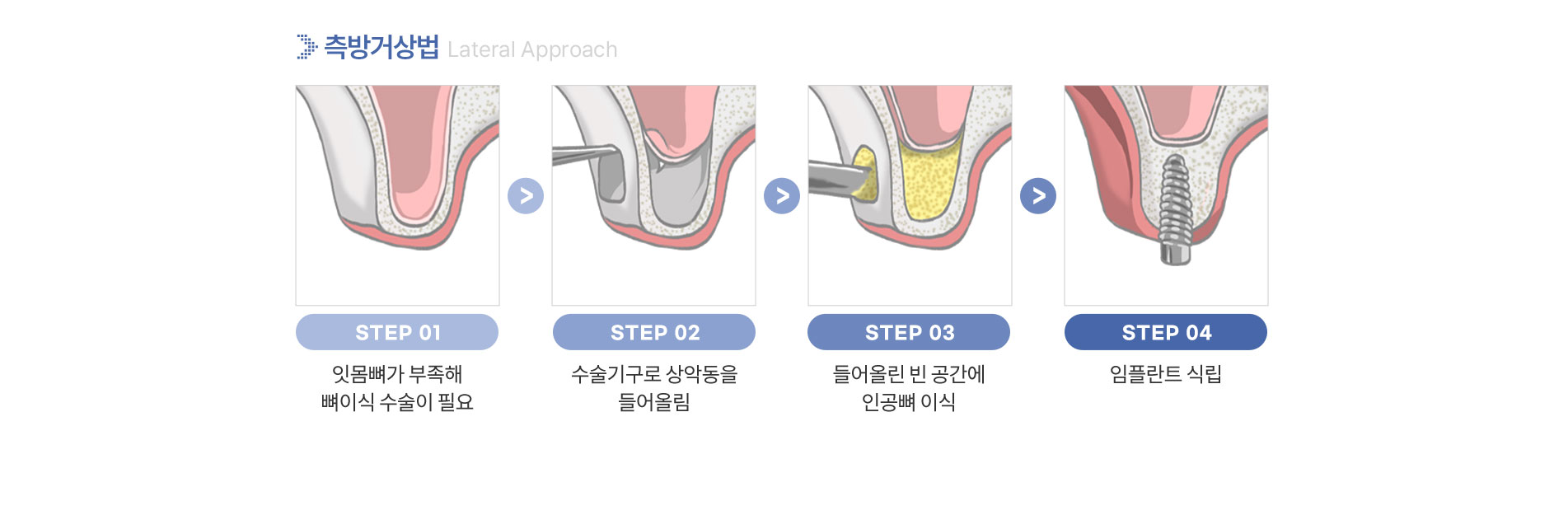 임플란트센터
