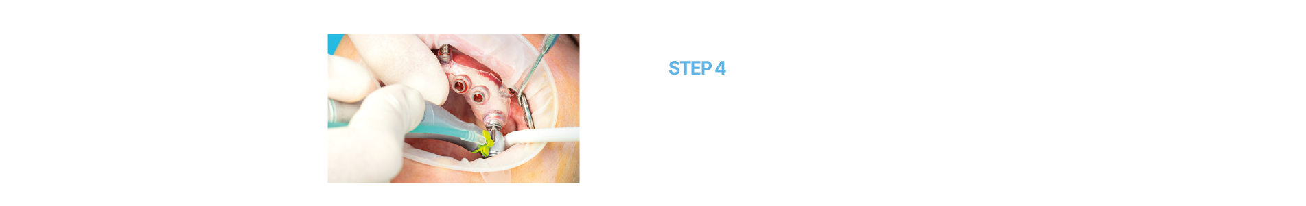 임플란트센터