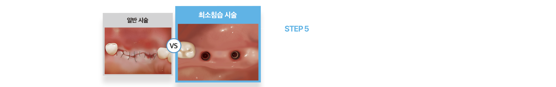 임플란트센터